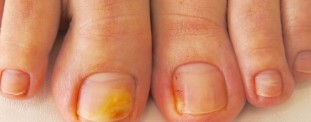 The main symptoms and pictures onychomycosis