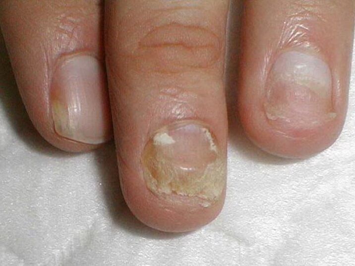 Treatment of Candida nail fungus