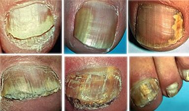 Onychomycosis at an advanced stage