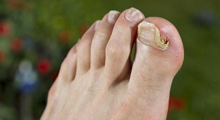 Damage to the nail plate on the feet with fungus