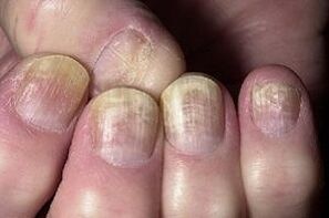 Nail change with fungal infection