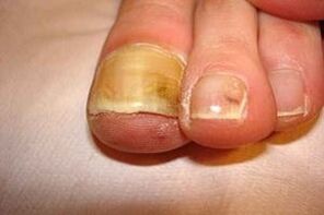 Neglected toenail fungus