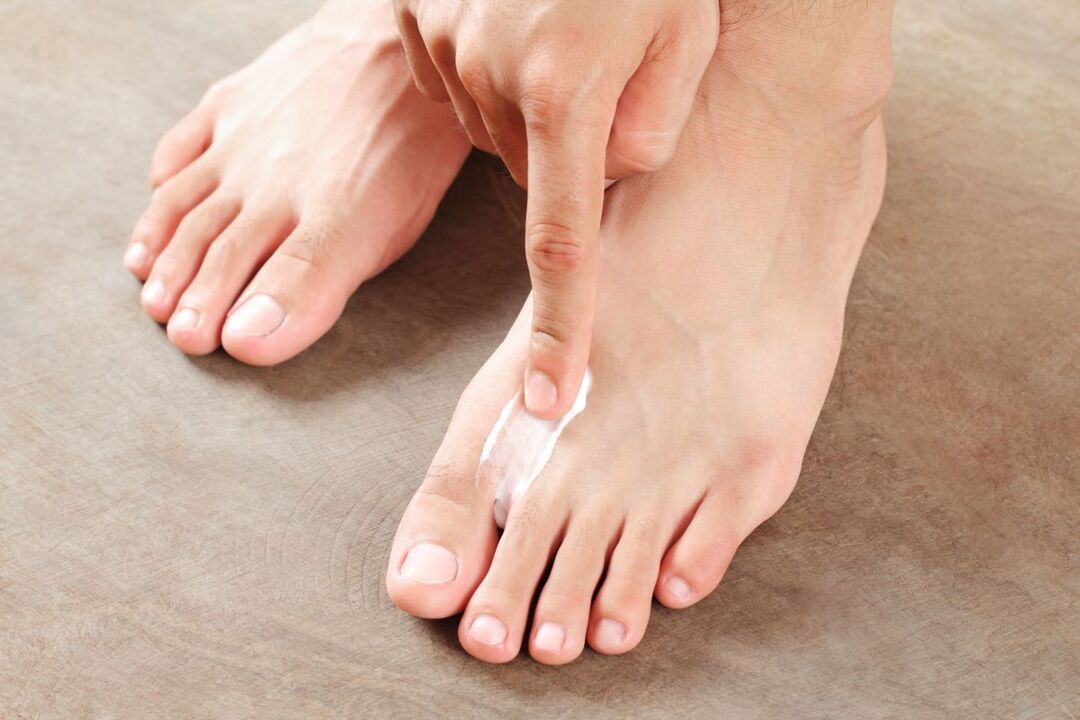 Treat fungus on the feet with ointments