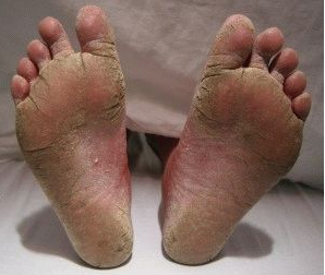 athlete's foot, as shown