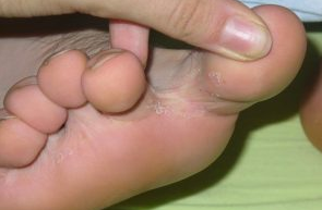 Fungus between the toes of the feet