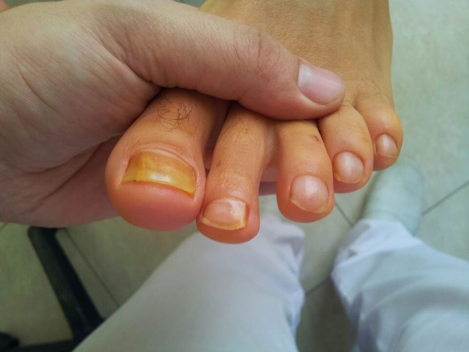 Yellowing of toenails with fungus