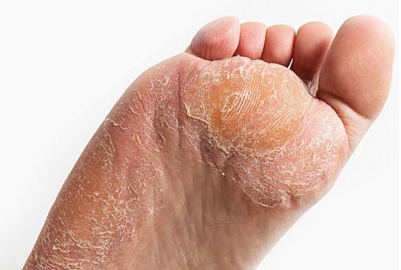 Exfoliation of the skin when infected with a fungus