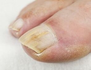 Anti-fungal drops should not be used for pus near the nail