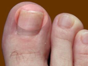 Toenail fungus - an indication for the use of fungicide drops