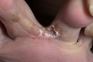 Skin fungus between the fingers