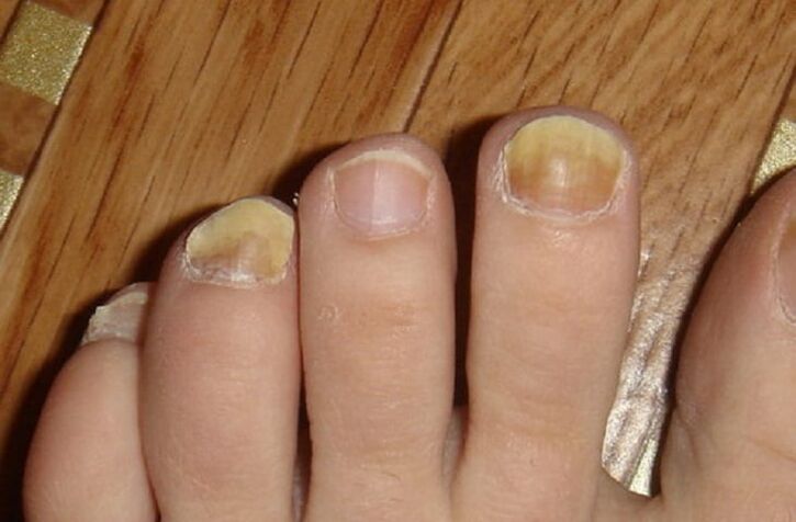 Symptoms of the fungus on the nails and skin of the feet
