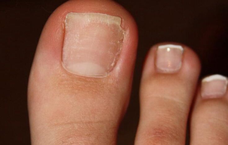 Symptoms of toe fungus