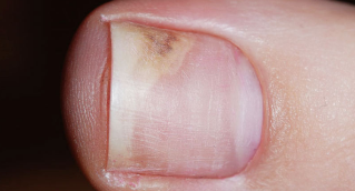 The symptoms at an early stage onychomycosis