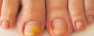 fungus of the nails in the feet symptoms