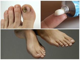 fungus of the nails of the feet treatment