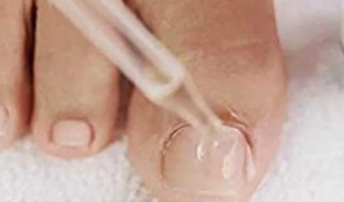 Drops of the nail fungus in the feet