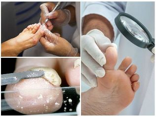 fungi in the skin of the foot diagnosis