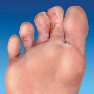 fungi on the skin of the feet