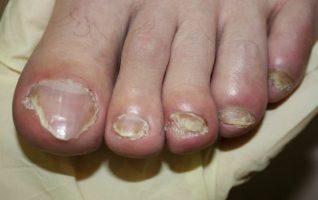 symptoms of fungus nail