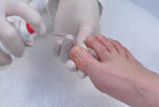 The treatment is performed nail fungus