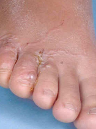 Fungus between toes