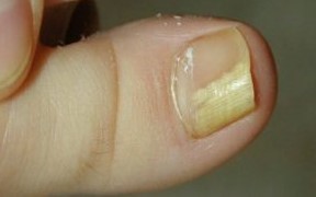 Fungus of the nail